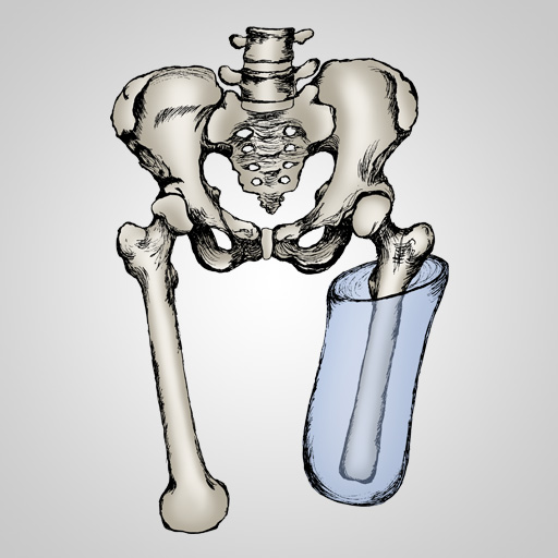 Transfemoral Brimless Interface, Vacuum Assisted Suspension Technique